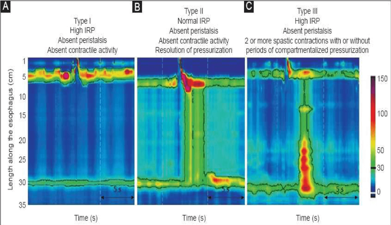 Experience Successful Per Oral Endoscopic Myotomy at GASTROQURE Hospital