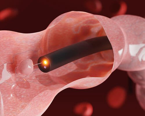 Colonic Tumor Removal