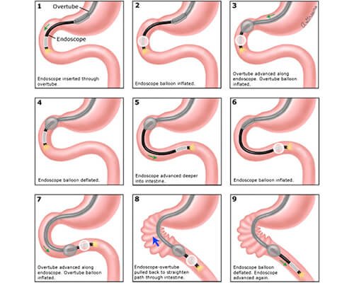 Double Balloon Enteroscopy & Capsule Endoscopy