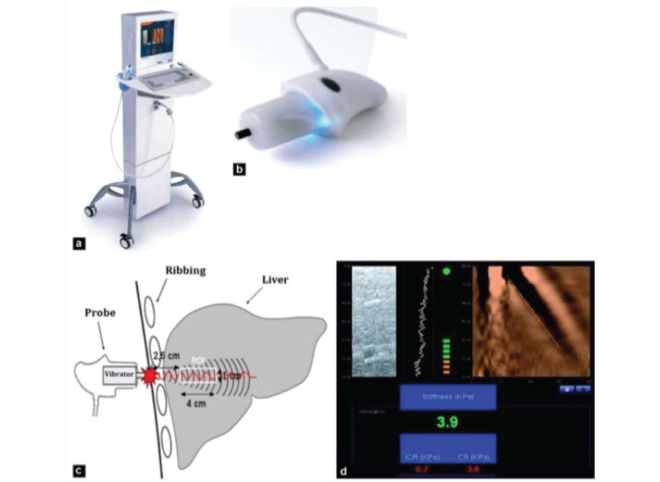 fibroscan fibroscan