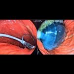 minimal-invasive-method-endoscopic-balloon-1536x579