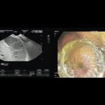 obstructive-jaundice-with-cholangitis