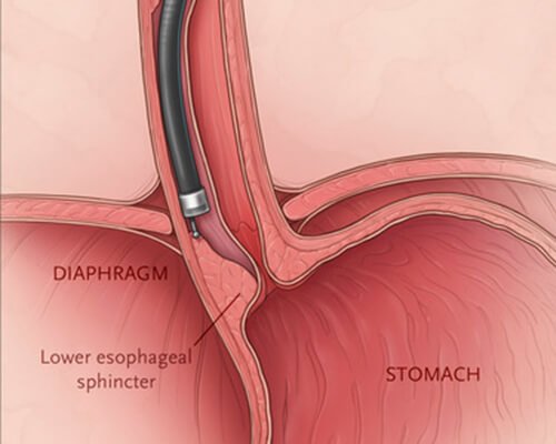 Per Oral Endoscopic Myotomy