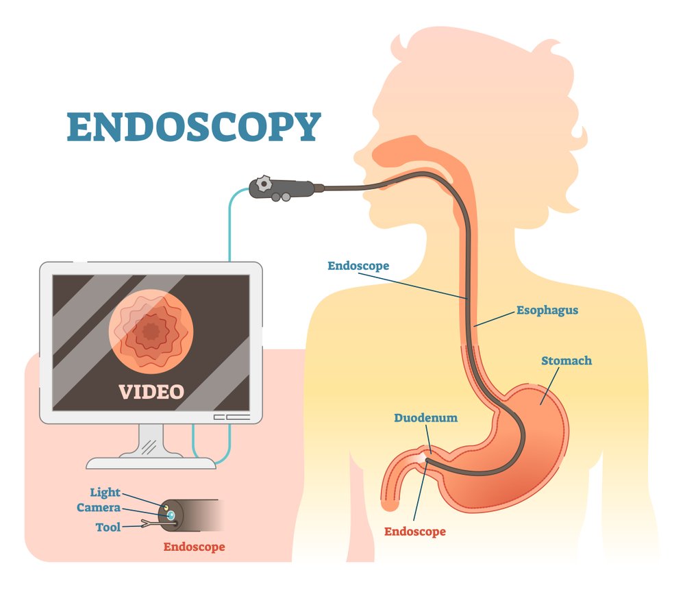UGI Endoscopy Procedure and Dietetics in Delhi Best Gastroenterology In