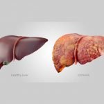 liver-cirrhosis