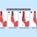 PERORAL ENDOSCOPIC MYOTOMY (POEM) NEW TOOL FOR TREATMENT OF ACHALASIA CARDIA