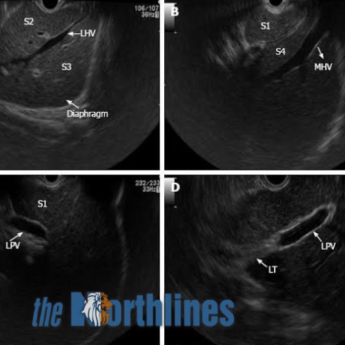 Endoscopic Ultrasound- A innovative Endoscopic Technique